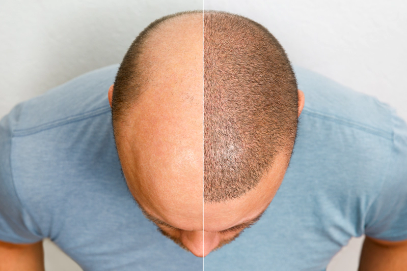 Hair transplant
