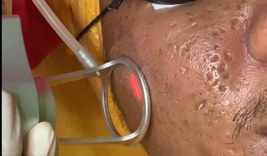 Mengatasi Bopeng: Solusi dengan Laser
