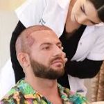 Perawatan Pasca Hair Transplant: Tips untuk Hasil Optimal