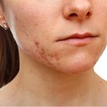Perawatan Setelah Laser Bopeng: Tips untuk Hasil Optimal