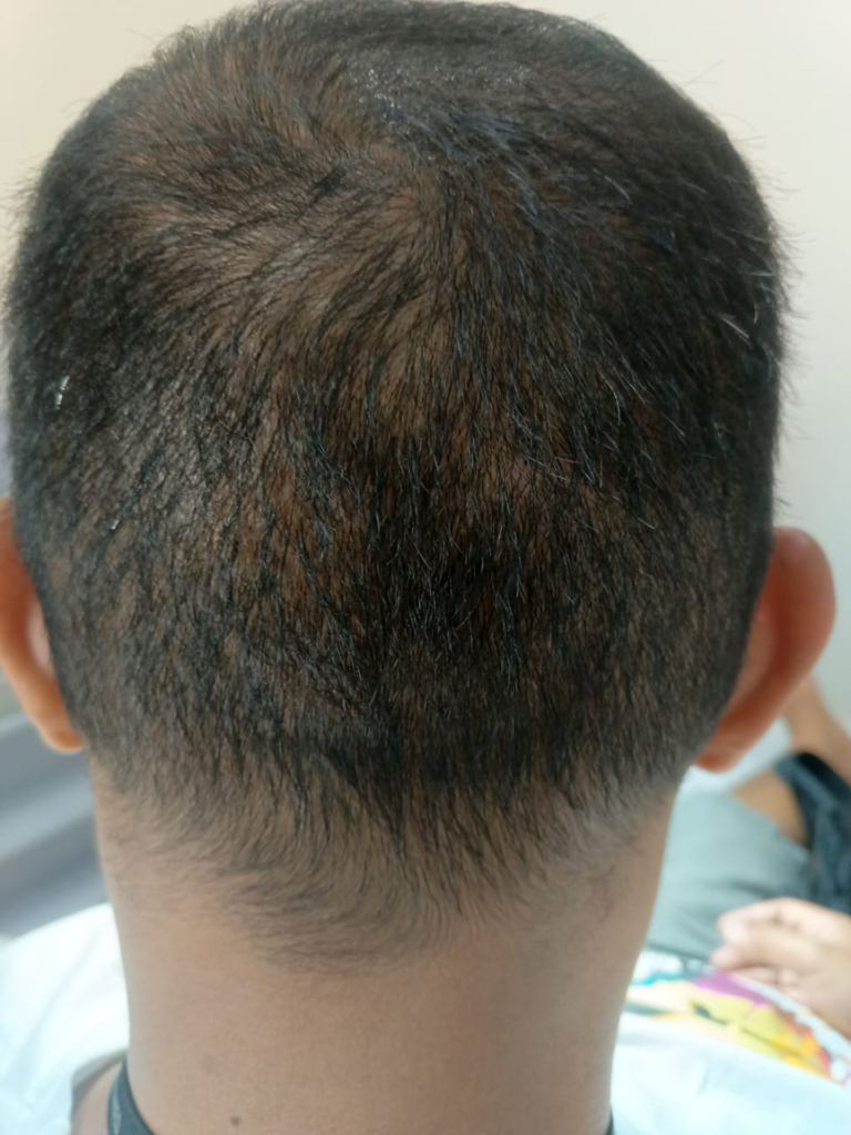 Hair Transplant Bogor Dermalight