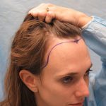 Hair Transplant: Kembalikan Percaya Dirimu!