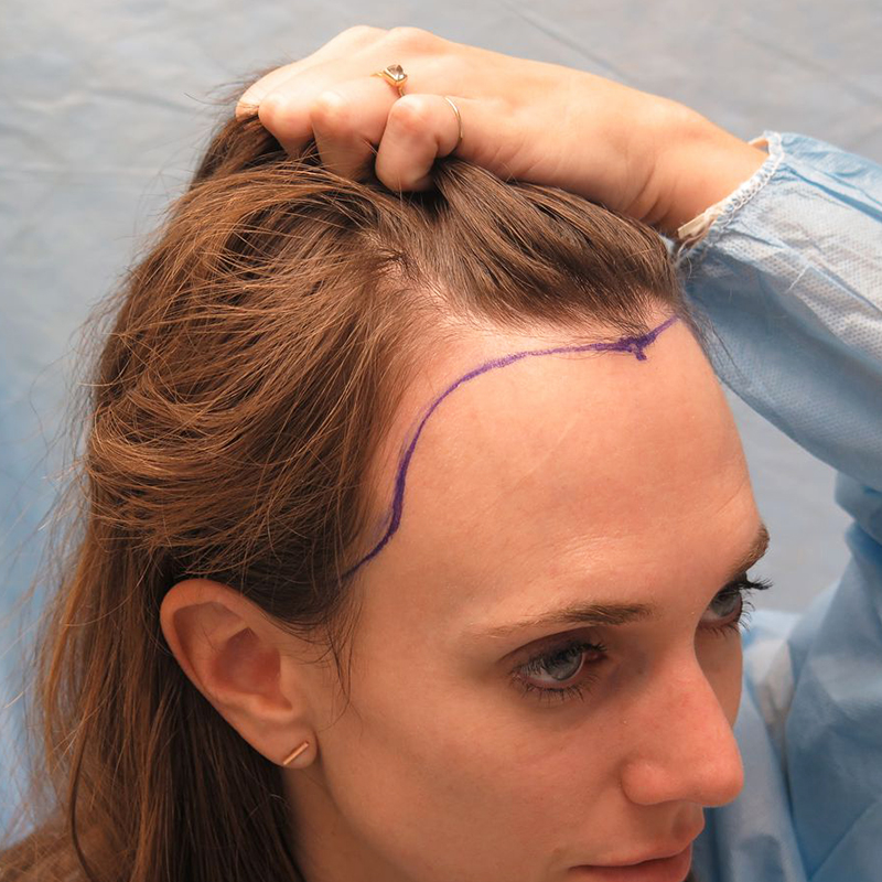 Hair Transplant: Kembalikan Percaya Dirimu!