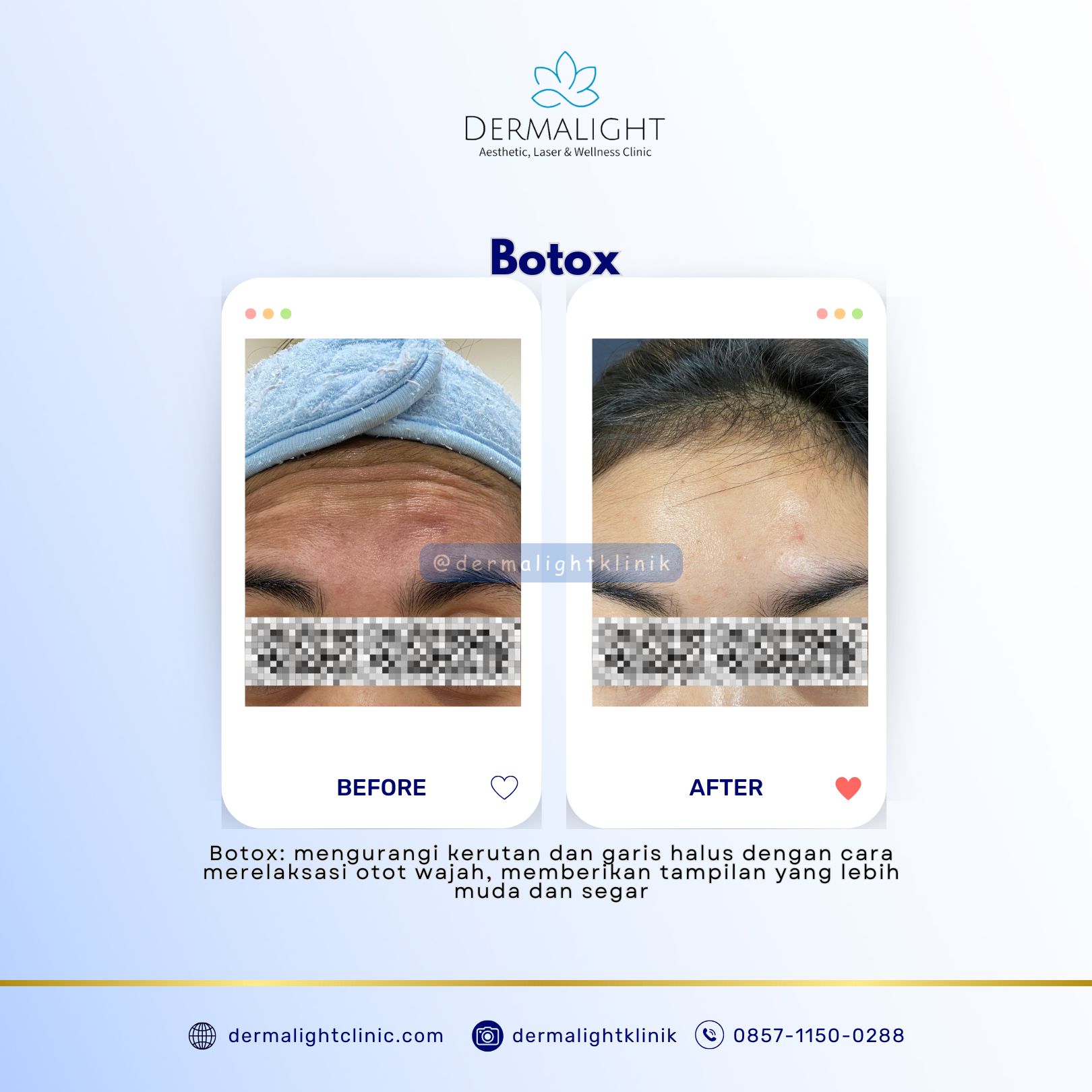 Harga Botox Bogor: Solusi Mengatasi Kerutan dan Garis Halus