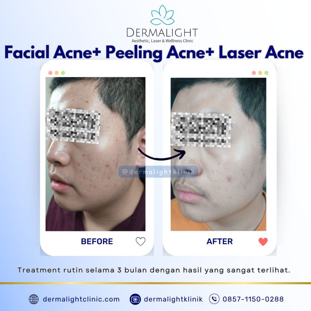before after Dermalight Clinic Bogor