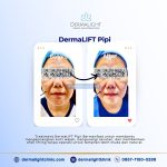 harga hifu korea di bogor