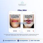 harga filler bogor