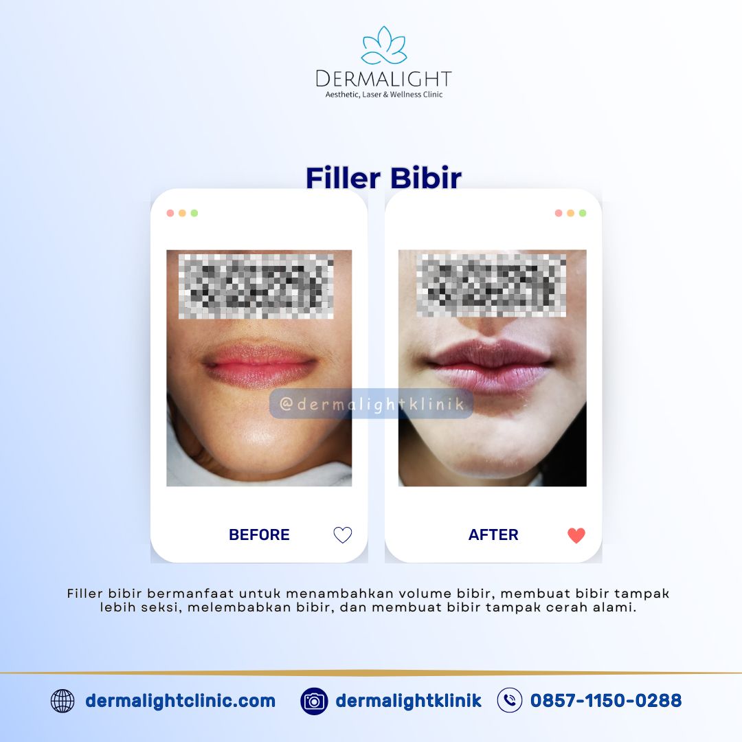 Harga Filler Bogor: Membentuk Kontur Wajah dengan Filler Terbaik