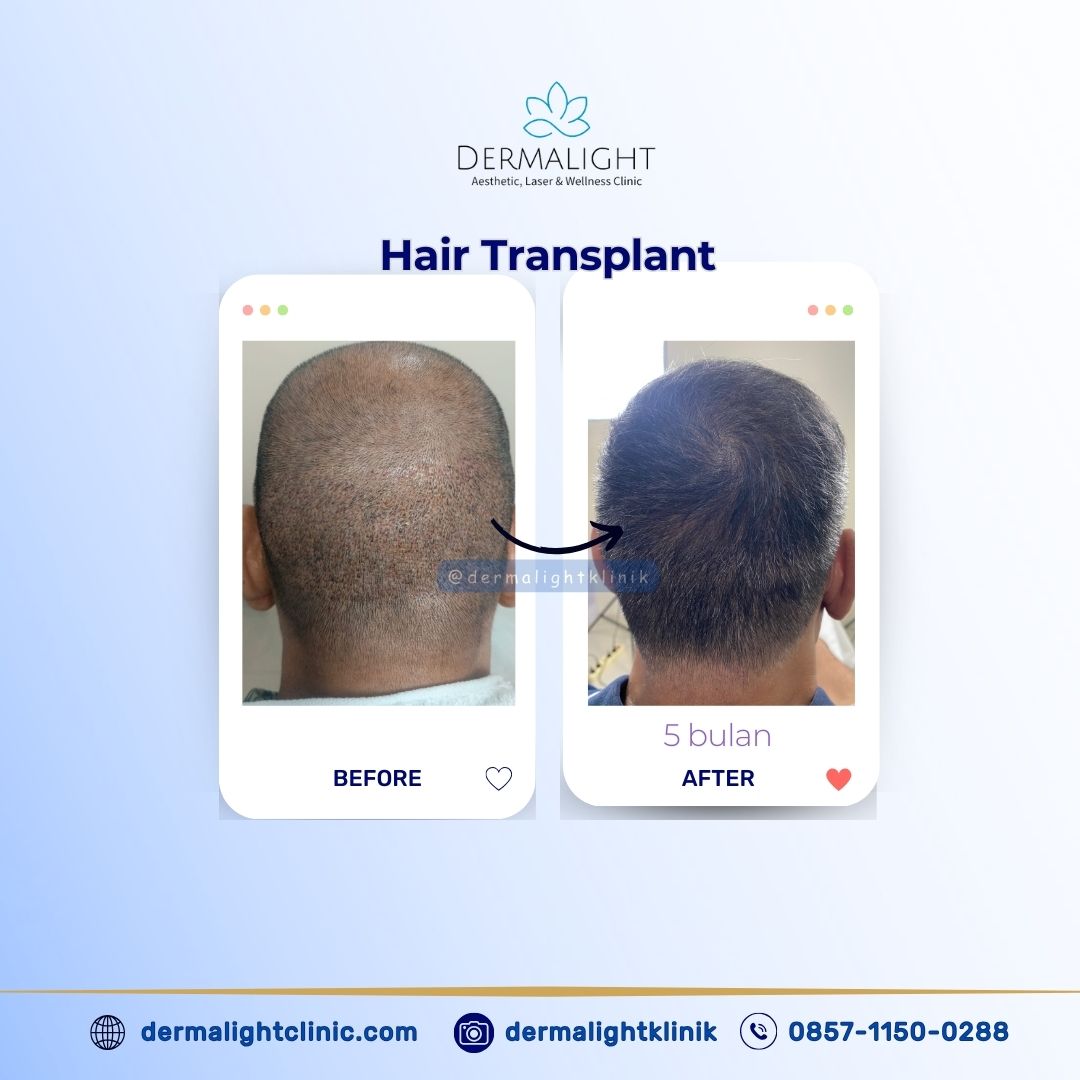Biaya Hair Transplant di Indonesia