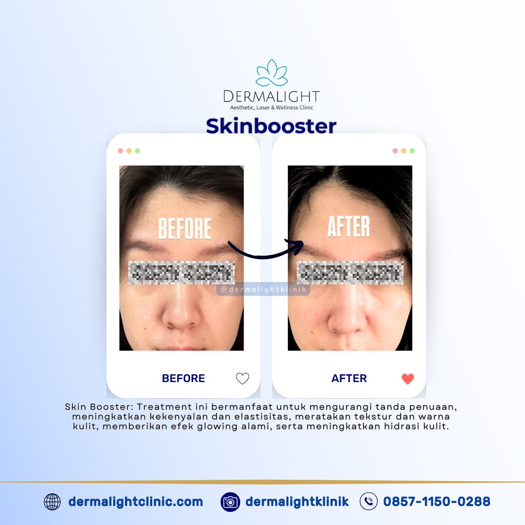 Biaya Skinbooster Korea di Bogor