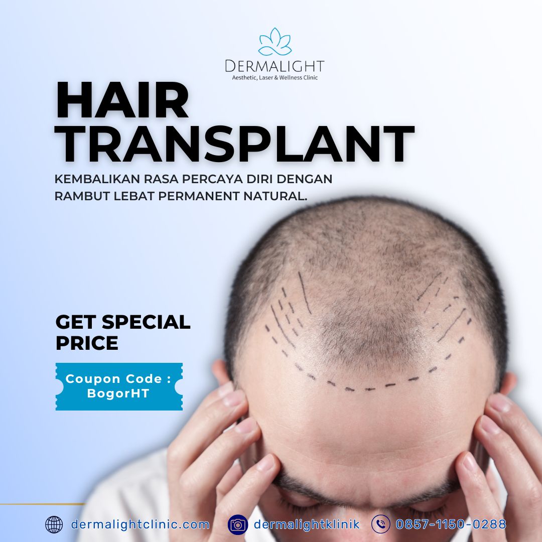 Biaya Hair Transplant di Jakarta
