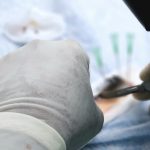 Biaya Hair Transplant Indonesia Dermalight