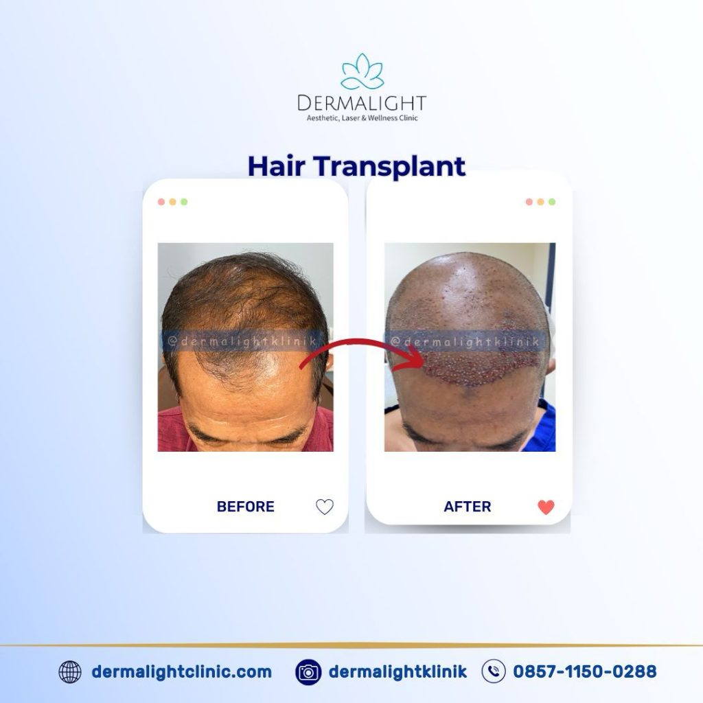 Before After Hair Transplant Bogor - Dermalight