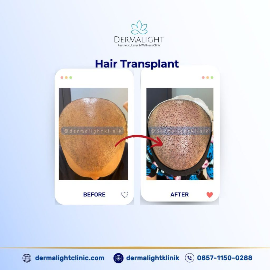 Before After Hair Transplant Bogor - Dermalight