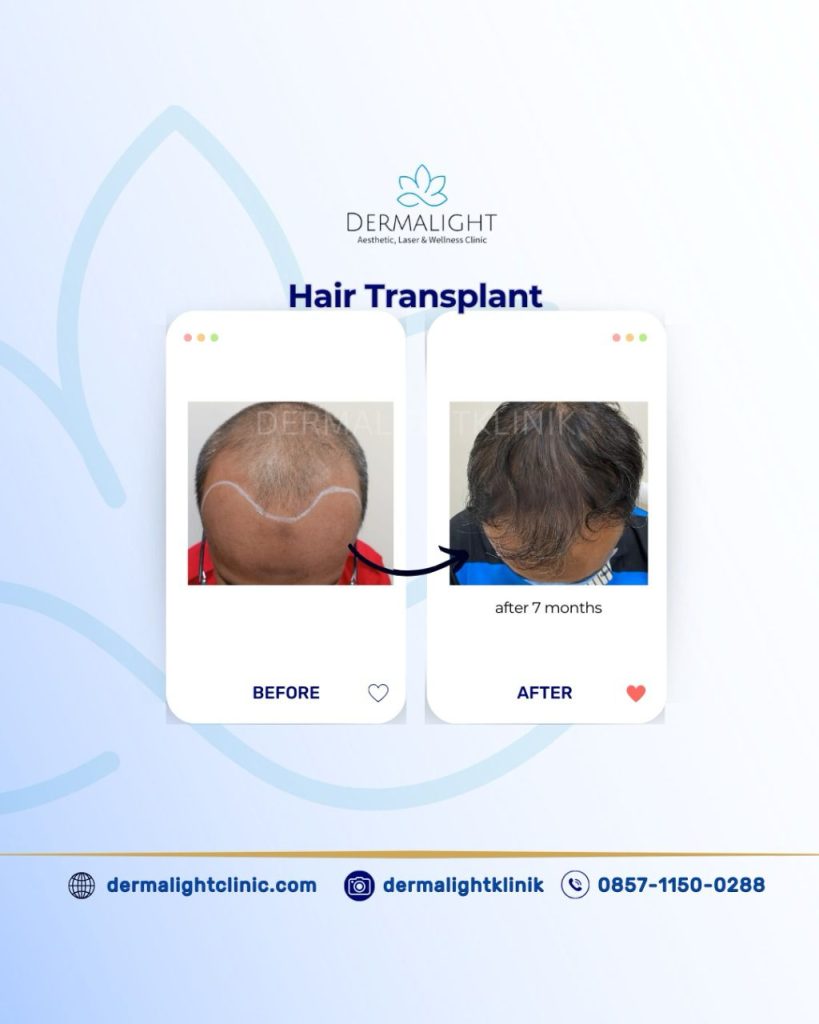Before After Hair Transplant Bogor - Dermalight