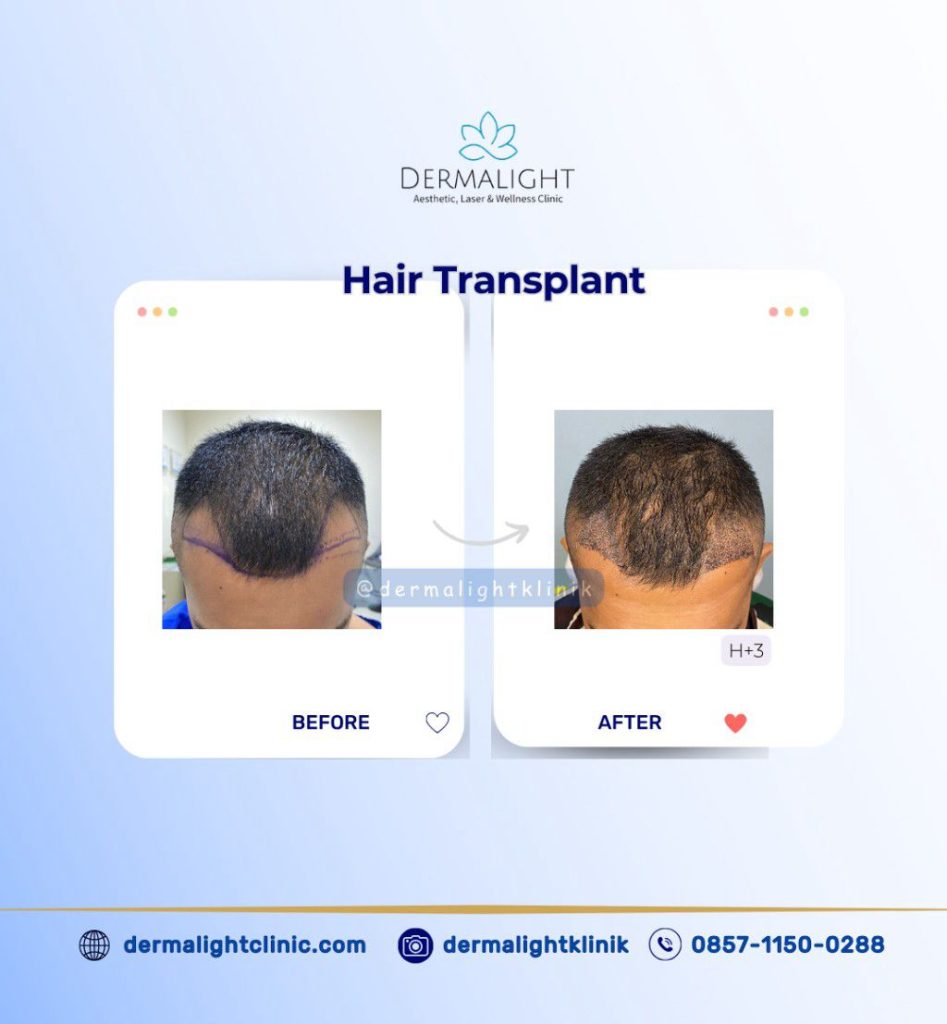 Before After Hair Transplant Bogor - Dermalight