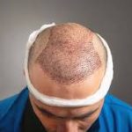 Panduan Hair Transplant untuk Pemula